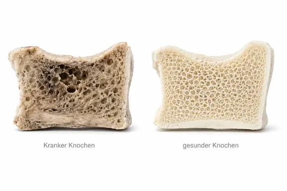 Vergleich zwischen krankem und gesundem Knochen