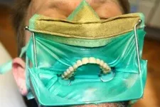Schutzmaßnahmen während der biologischen Amalgamentfernung mit Kofferdam und Nasenschutz