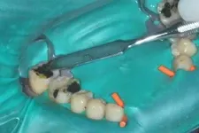 Nachbehandlung nach der biologischen Amalgamentfernung mit provisorischer Zahnversorgung